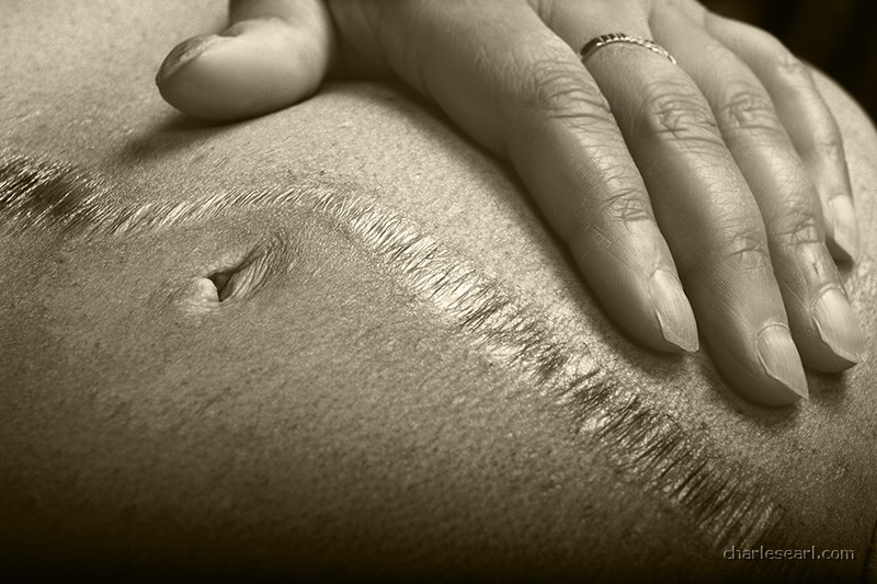 Scar #1